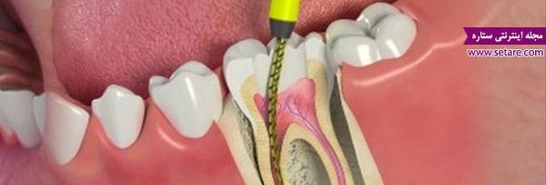 عصب کشی دندان و علل درد پس از آن چیست؟